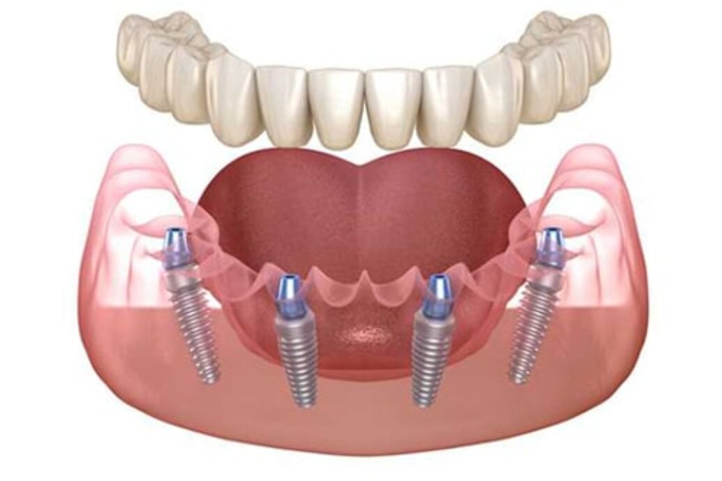 blog inner thumb : Tavern Street Dental Practice